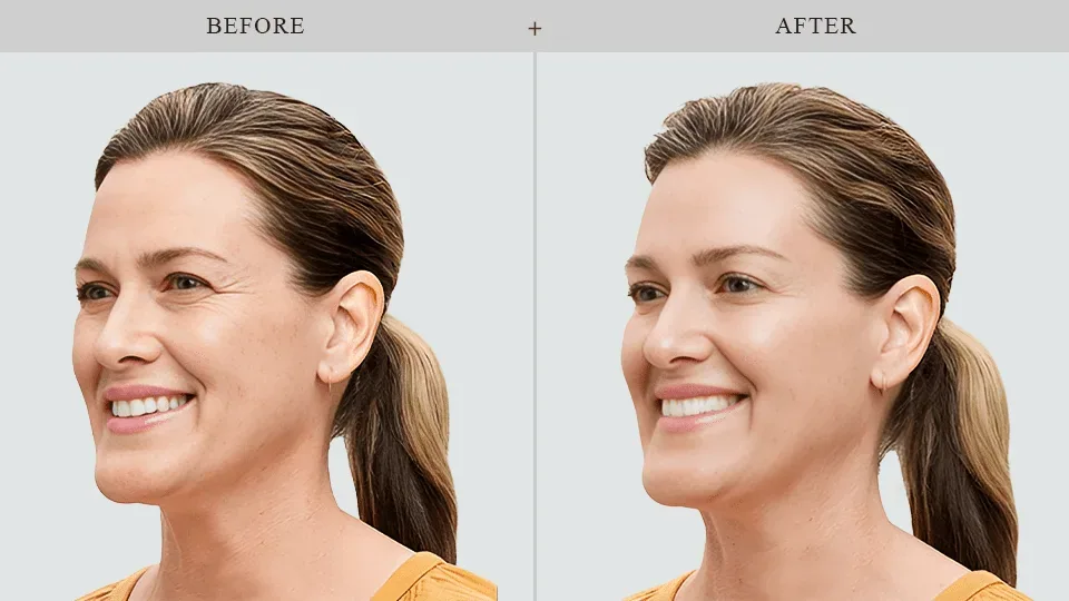 Botox® Results