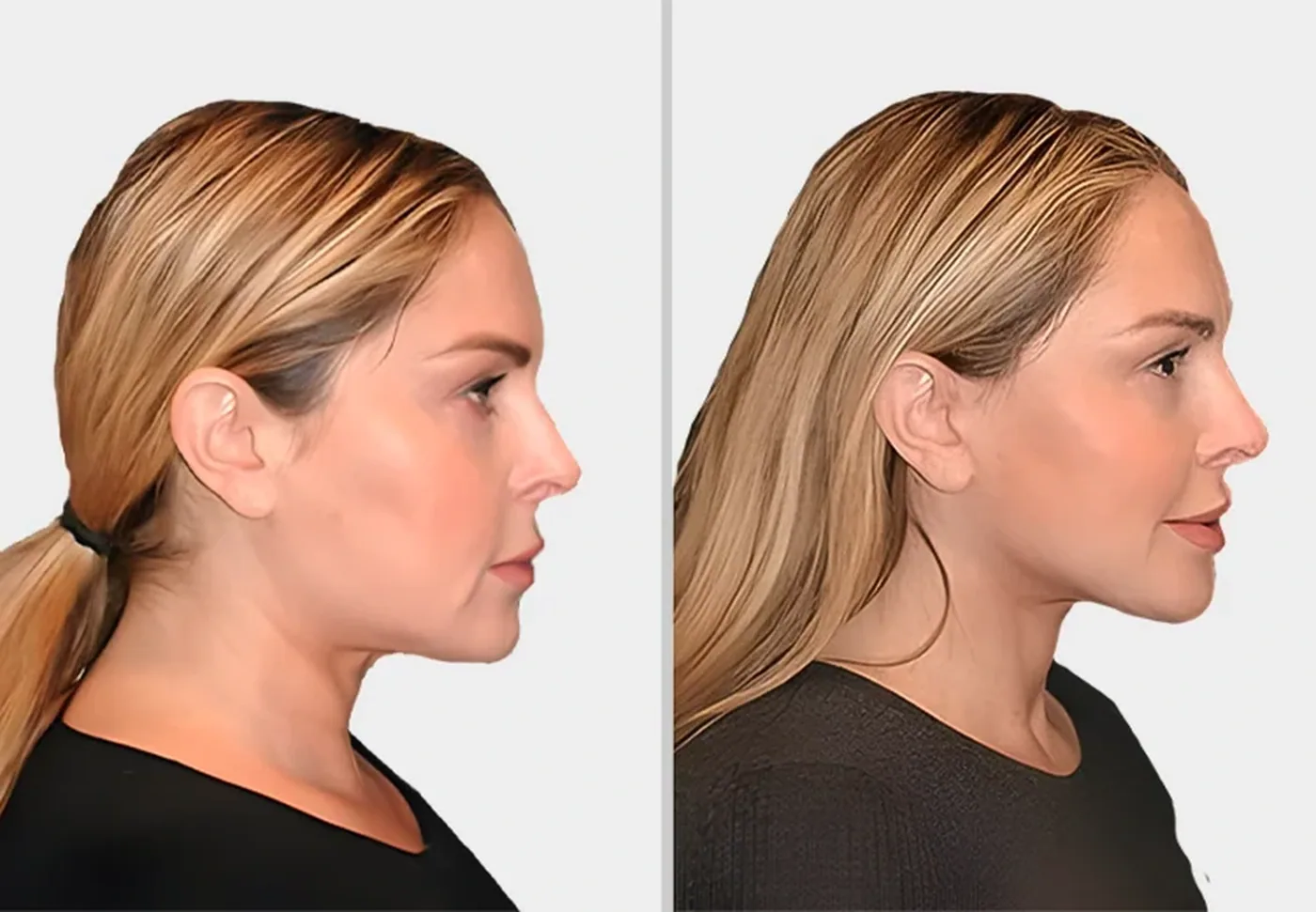 Dermal Fillers
