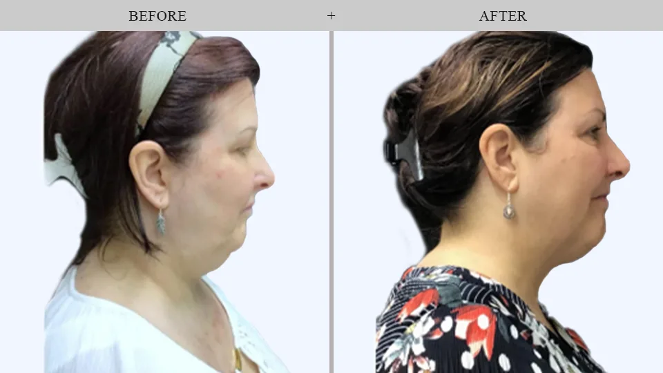 CoolSculpting® Results