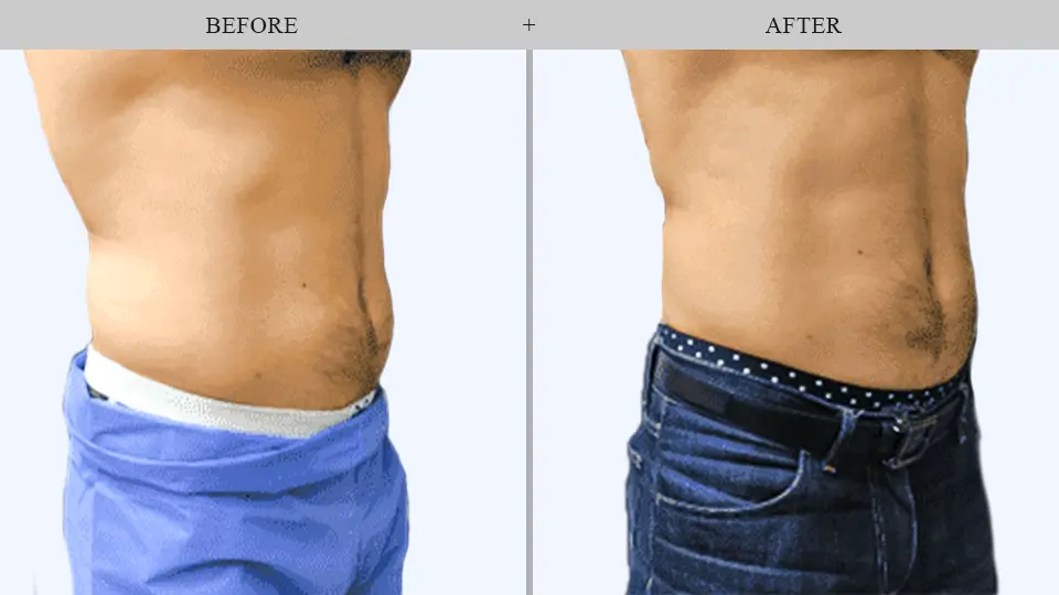 EmSculpt®