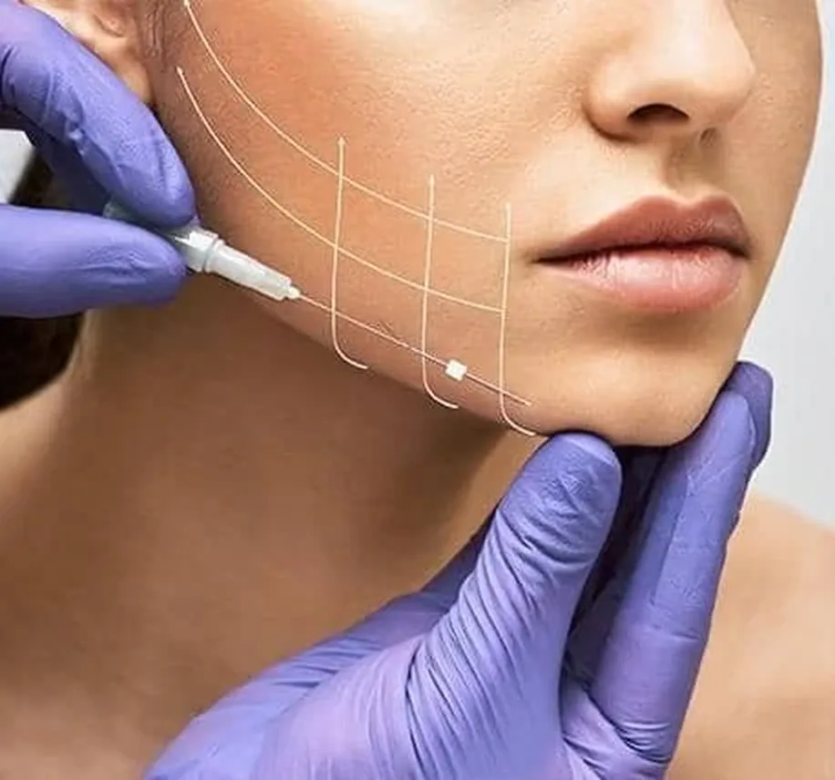 Threadlift