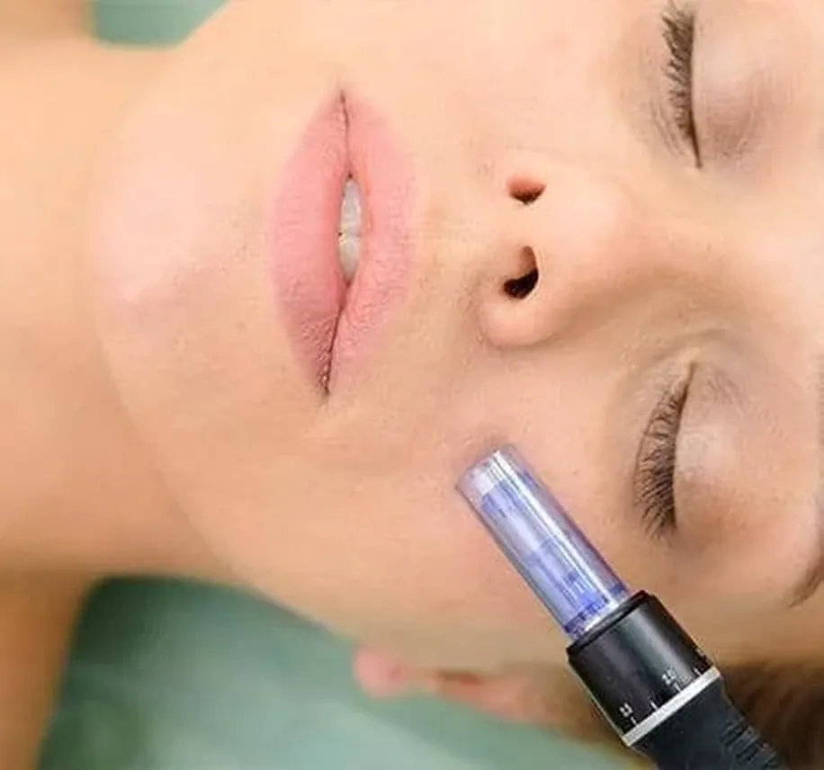 Microneedling