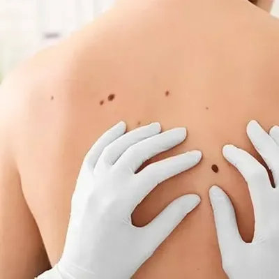 Skin Cancer