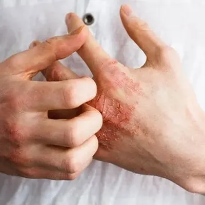 Eczema