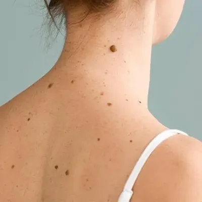 Moles