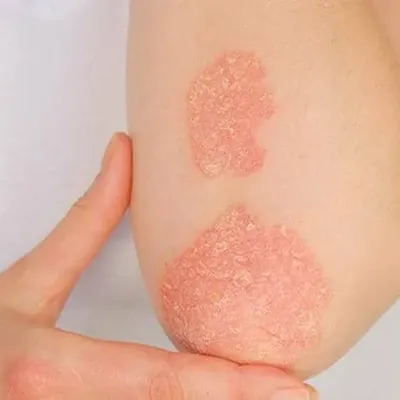 Psoriasis