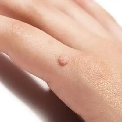 Warts