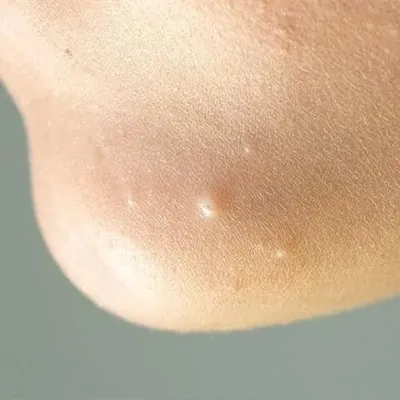 Molluscum