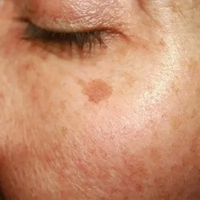 Age Spots