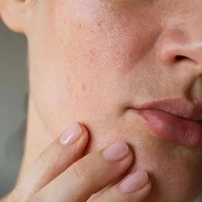 Hyperhidrosis